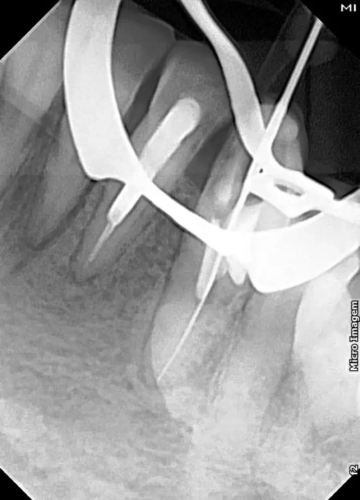 Radiografia inicial do caso 1