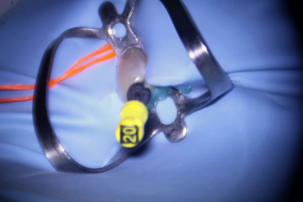 Acesso realizado sob isolamento absoluto e microscópio