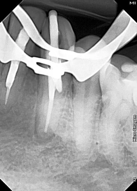 Radiografia de controle após o tratamento