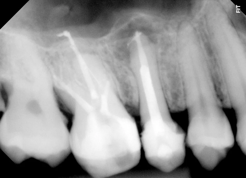 Radiografia pré-operatória do caso 2