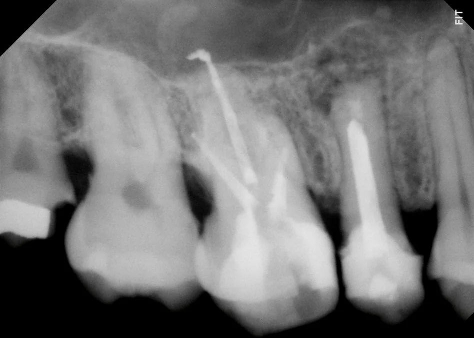 Radiografia pós-operatória imediata