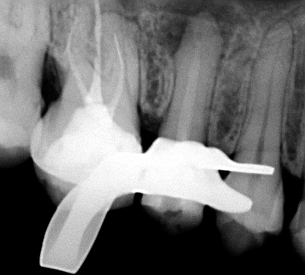 Radiografia inicial do caso 3, com pino de fibra de vidro instalado