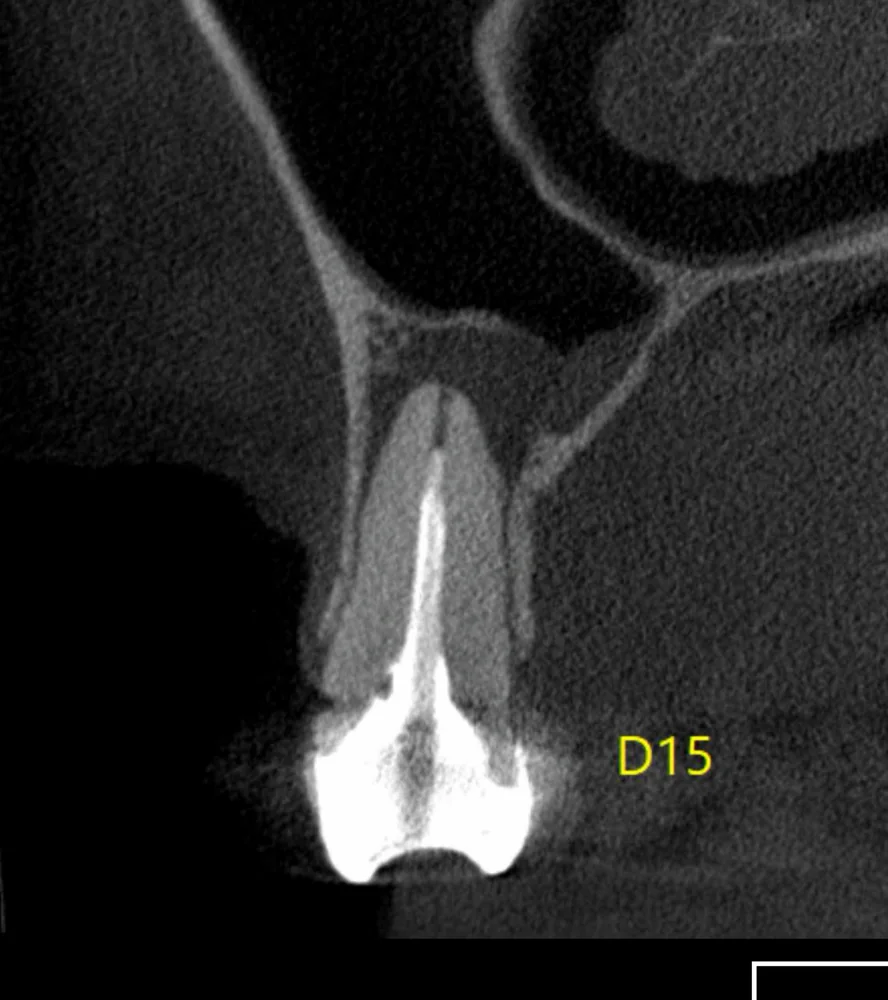 Corte tomográfico pré-operatório do dente com pino de fibra de vidro