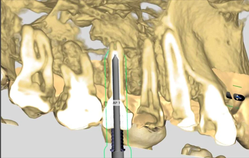 Reconstrução tridimensional com a trajetória planejada até o pino