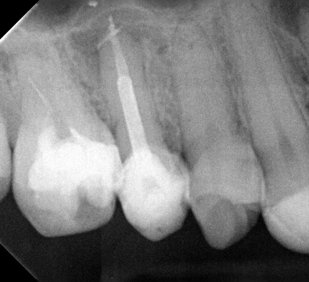 Radiografia final após a remoção do pino e o tratamento