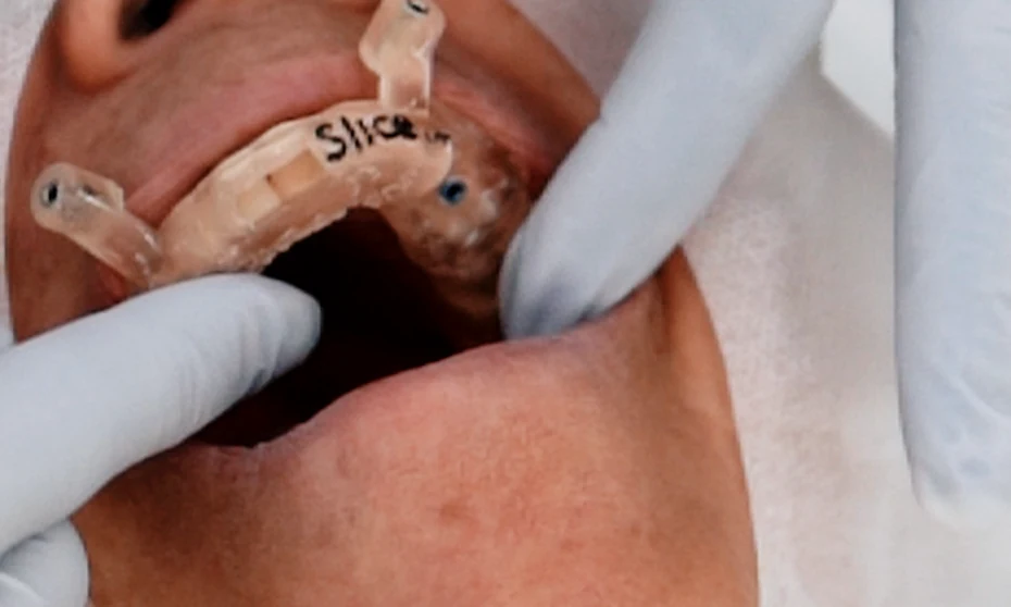 Guia de Endodontia Guiada posicionado na boca do paciente